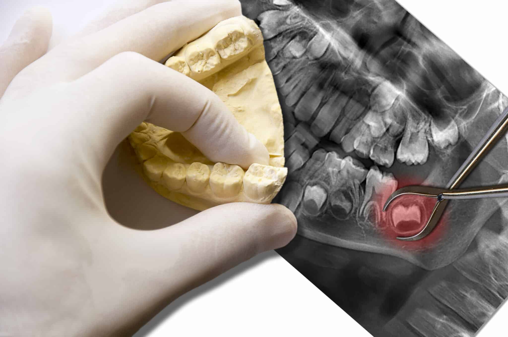 Wisdom Teeth Removal Toronto | Extraction of impacted tooth