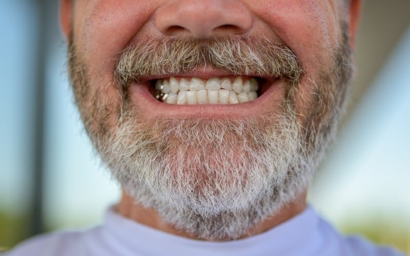 bearded man gold fillings giving toothy smile close his teeth