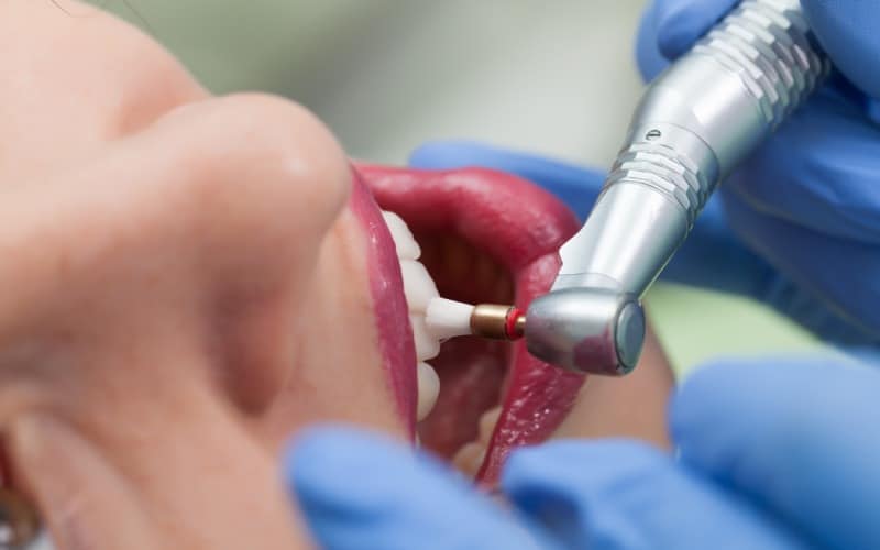 close up medical dentist procedure of teeth polish
